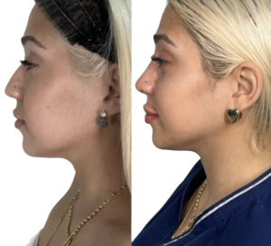 Before and after image showcasing a successful non surgical nose job procedure at our Miami-based medical spa. The 'before' image depicts the original nose structure, while the 'after' image reveals the enhanced and refined nose contour achieved through our expert cosmetic procedures.